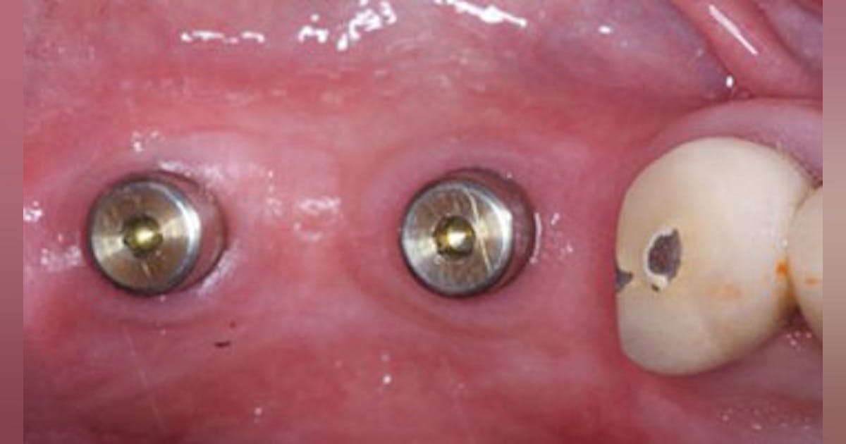 Illustrative example of dental implant code from Google Search