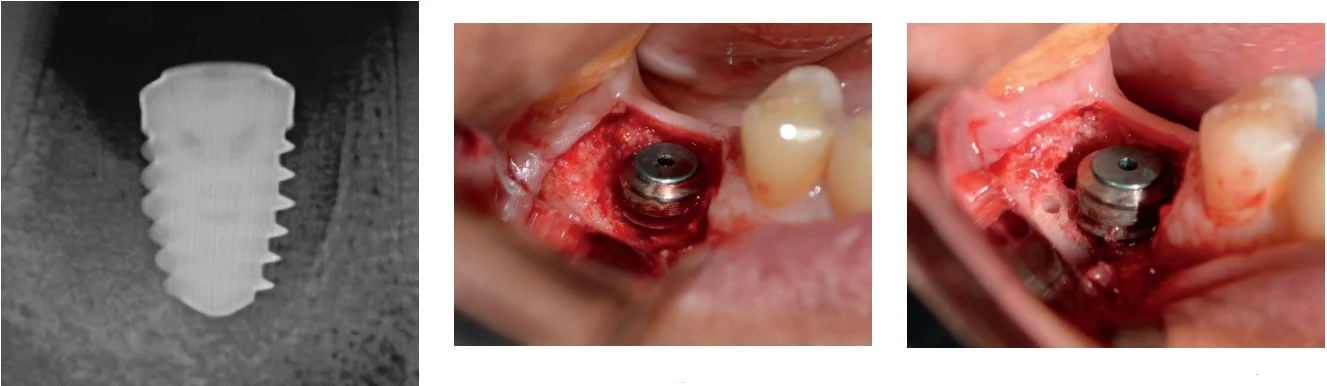 Illustrative example of dental implant failure after 10 years from Google Search