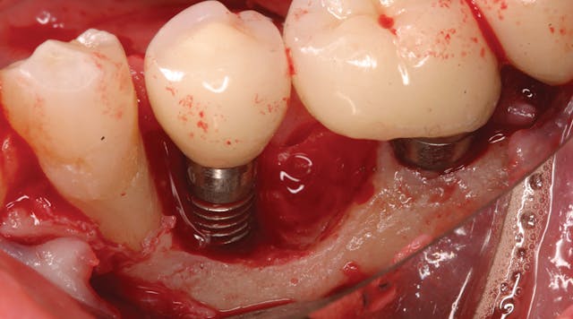 Illustrative example of dental implant failure after 10 years from Google Search