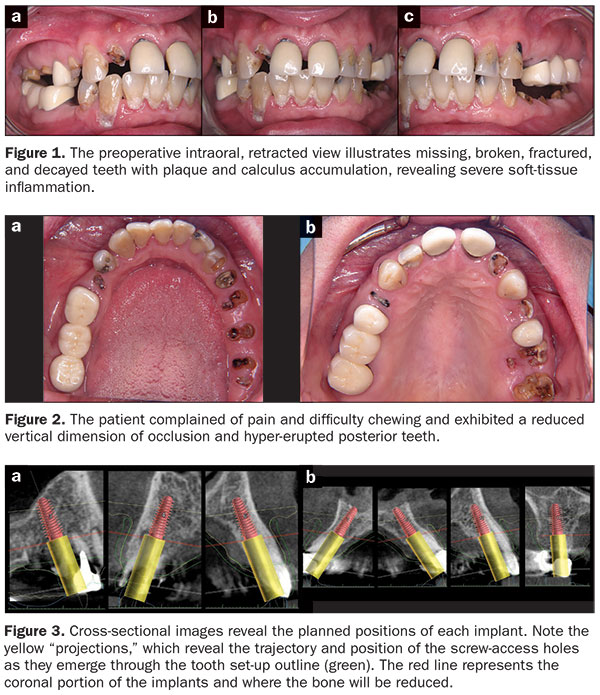 Illustrative example of dental implant gallery from Google Search