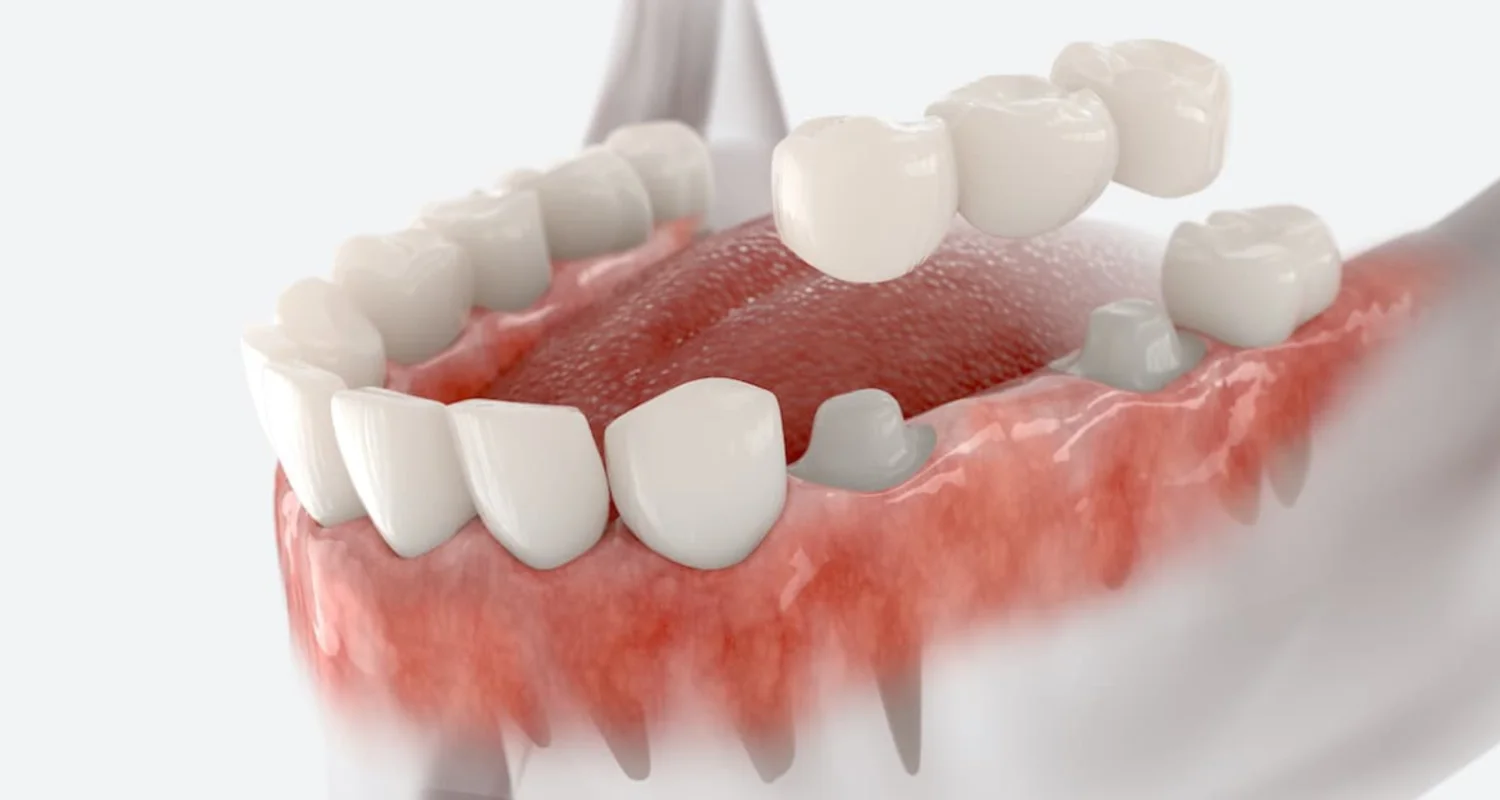 Illustrative example of dental implant glue from Google Search