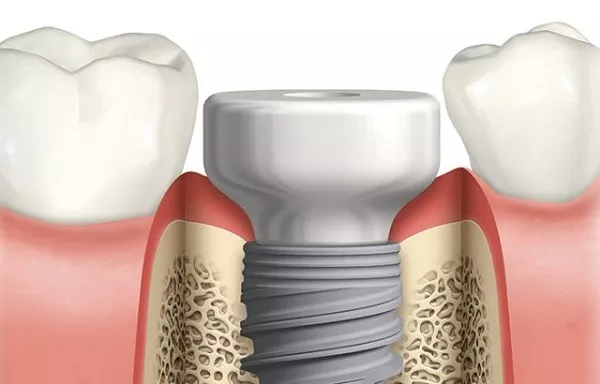 Illustrative example of dental implant healing from Google Search