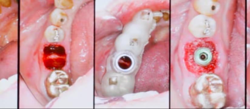 Illustrative example of dental implant healing stages from Google Search