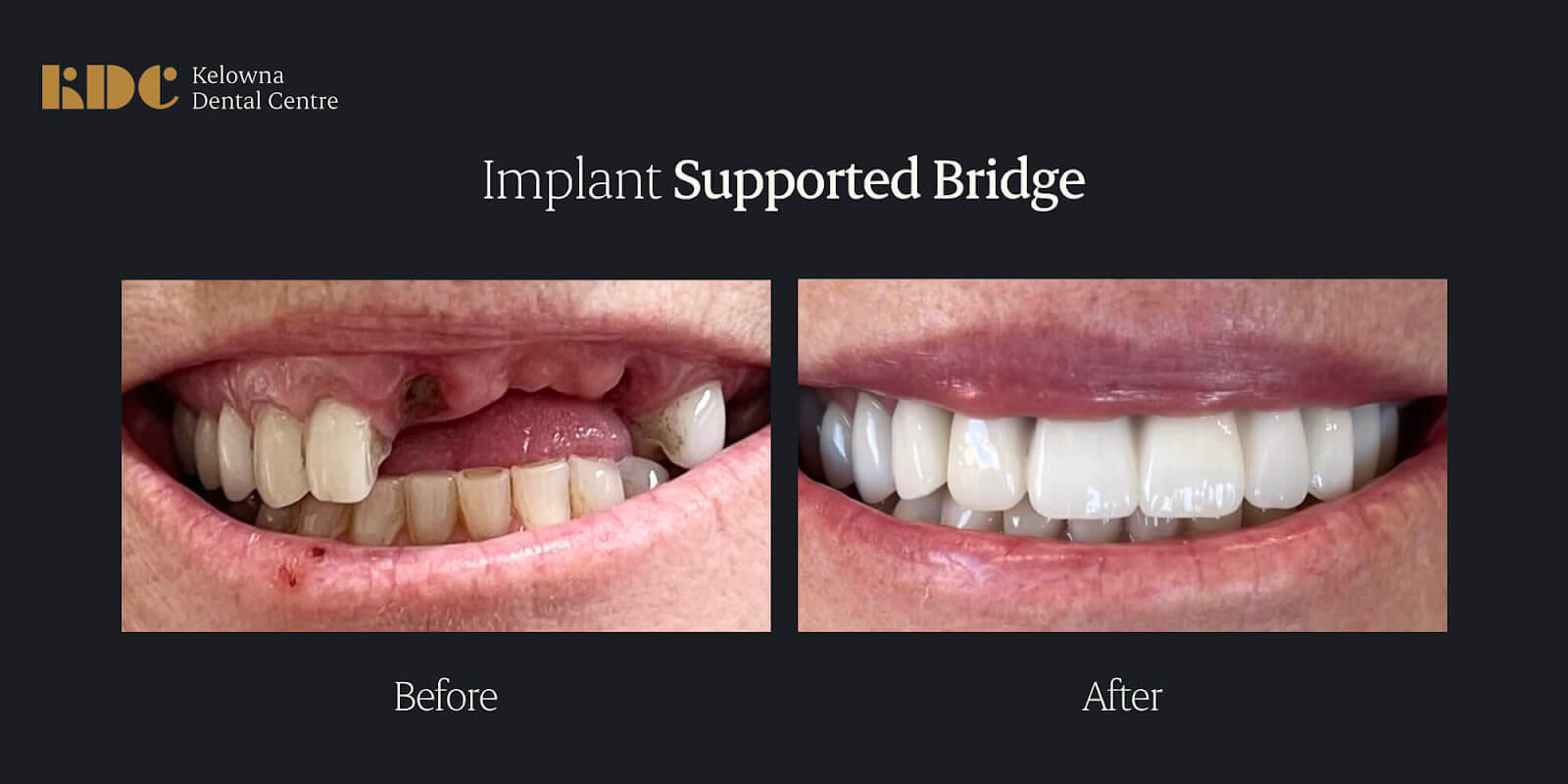 Illustrative example of dental implant healing stages pictures from Google Search
