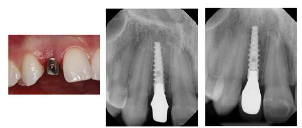 Illustrative example of dental implant lateral incisor from Google Search