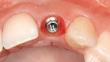 Illustrative example of dental implant lateral incisor from Google Search