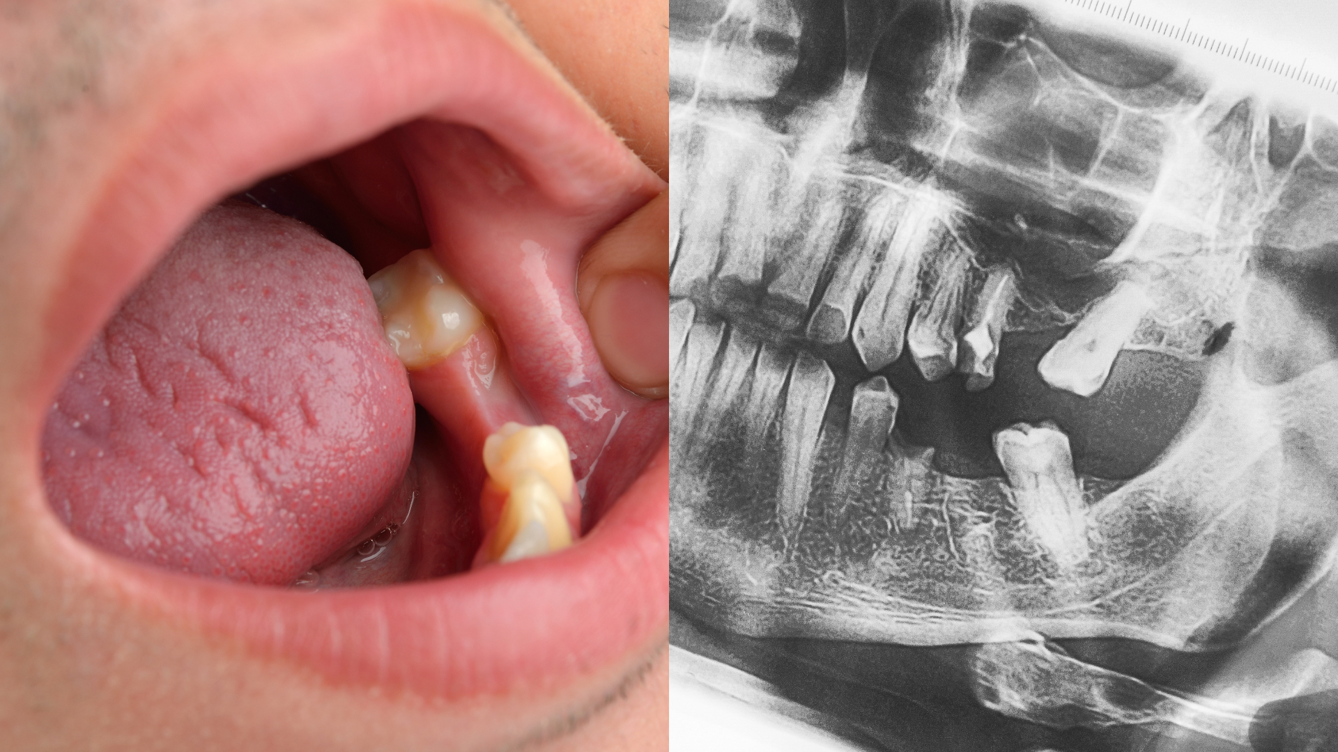 Illustrative example of dental implant molar tooth from Google Search