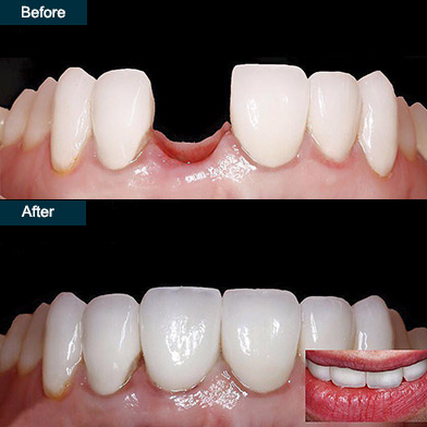 Illustrative example of dental implant molar tooth from Google Search