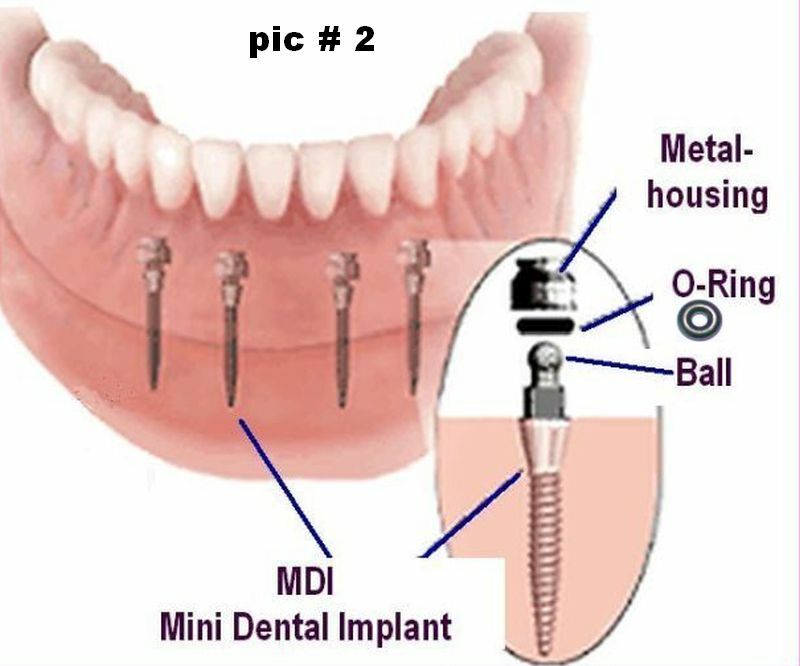 Illustrative example of dental implant o rings from Google Search