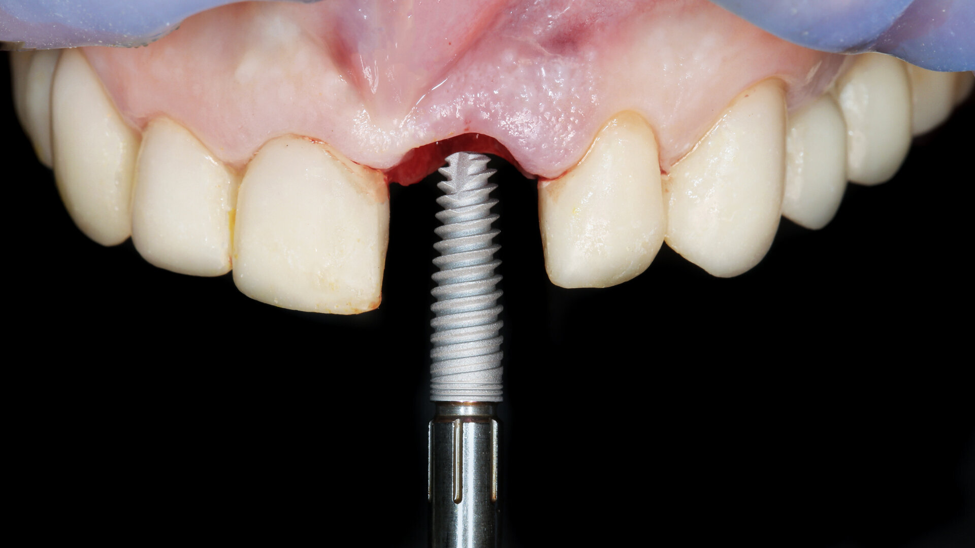 Illustrative example of dental implant photos from Google Search