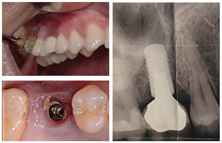 Illustrative example of dental implant repair from Google Search
