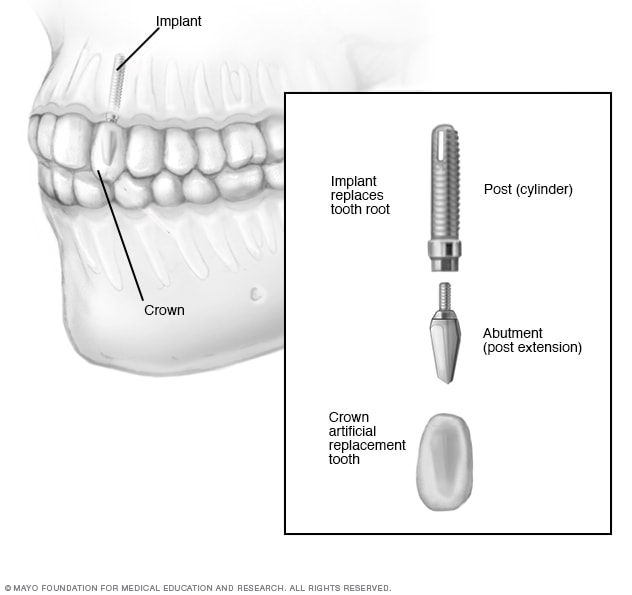 Illustrative example of dental implant repair from Google Search