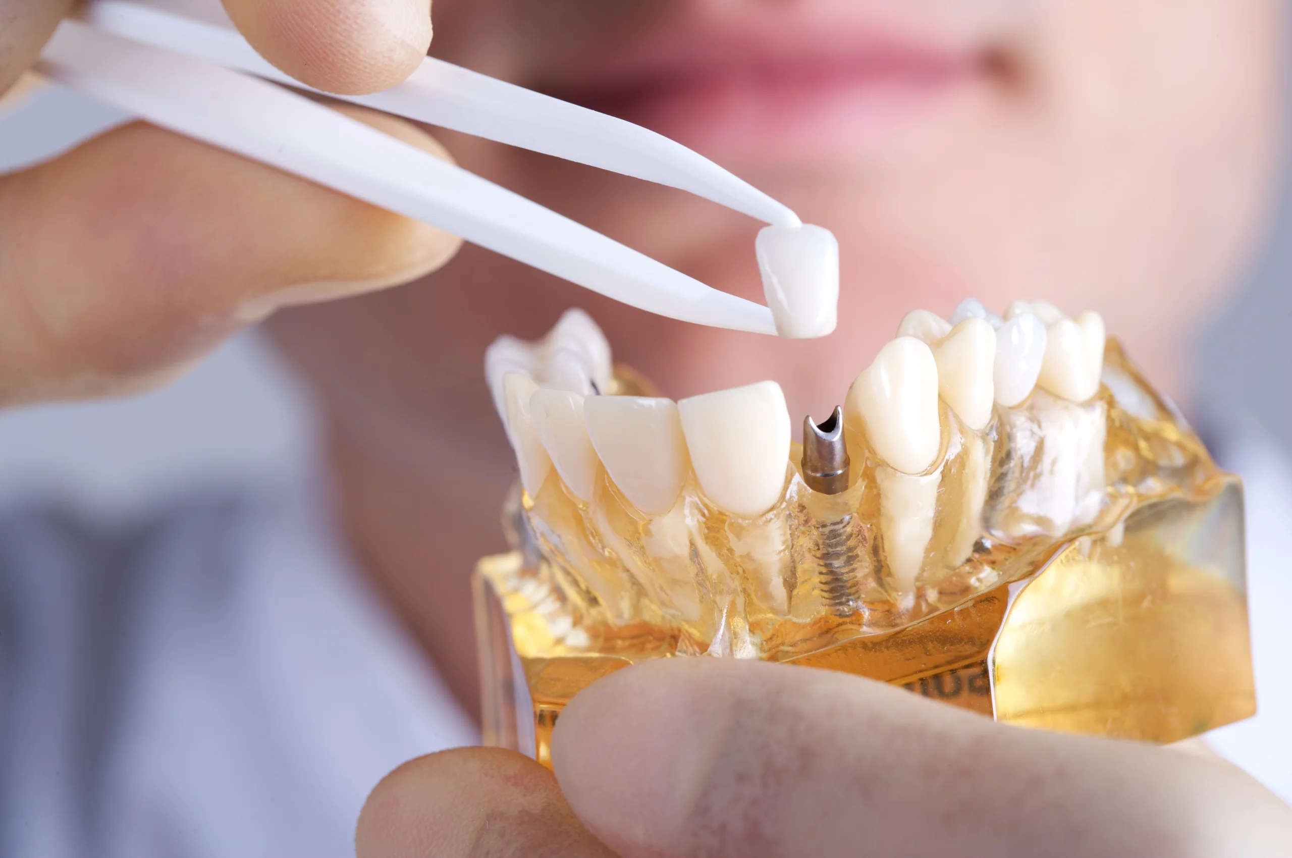 Illustrative example of dental implant soreness from Google Search