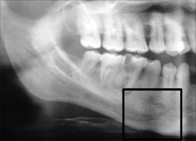 Illustrative example of dental implant soreness from Google Search