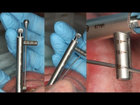 Illustrative example of dental implant torque wrench from Google Search