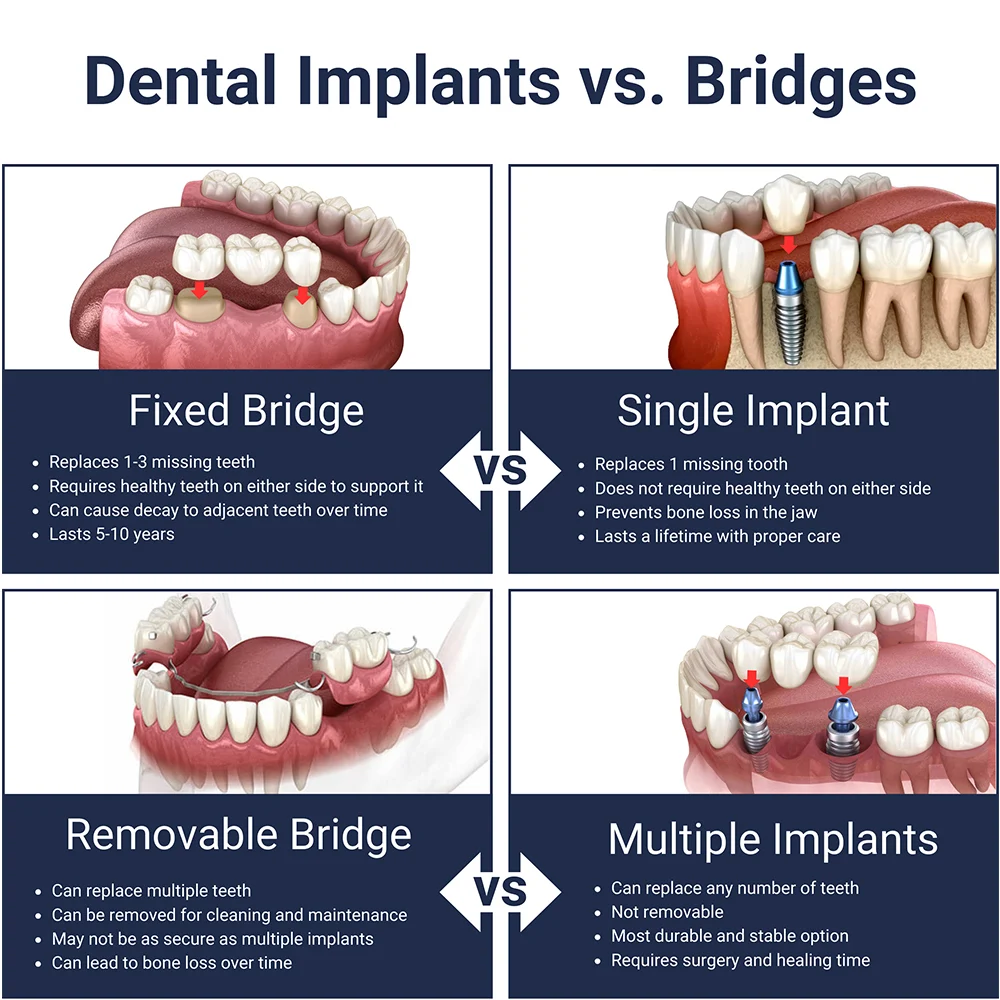 Illustrative example of dental implant versus bridge cost from Google Search