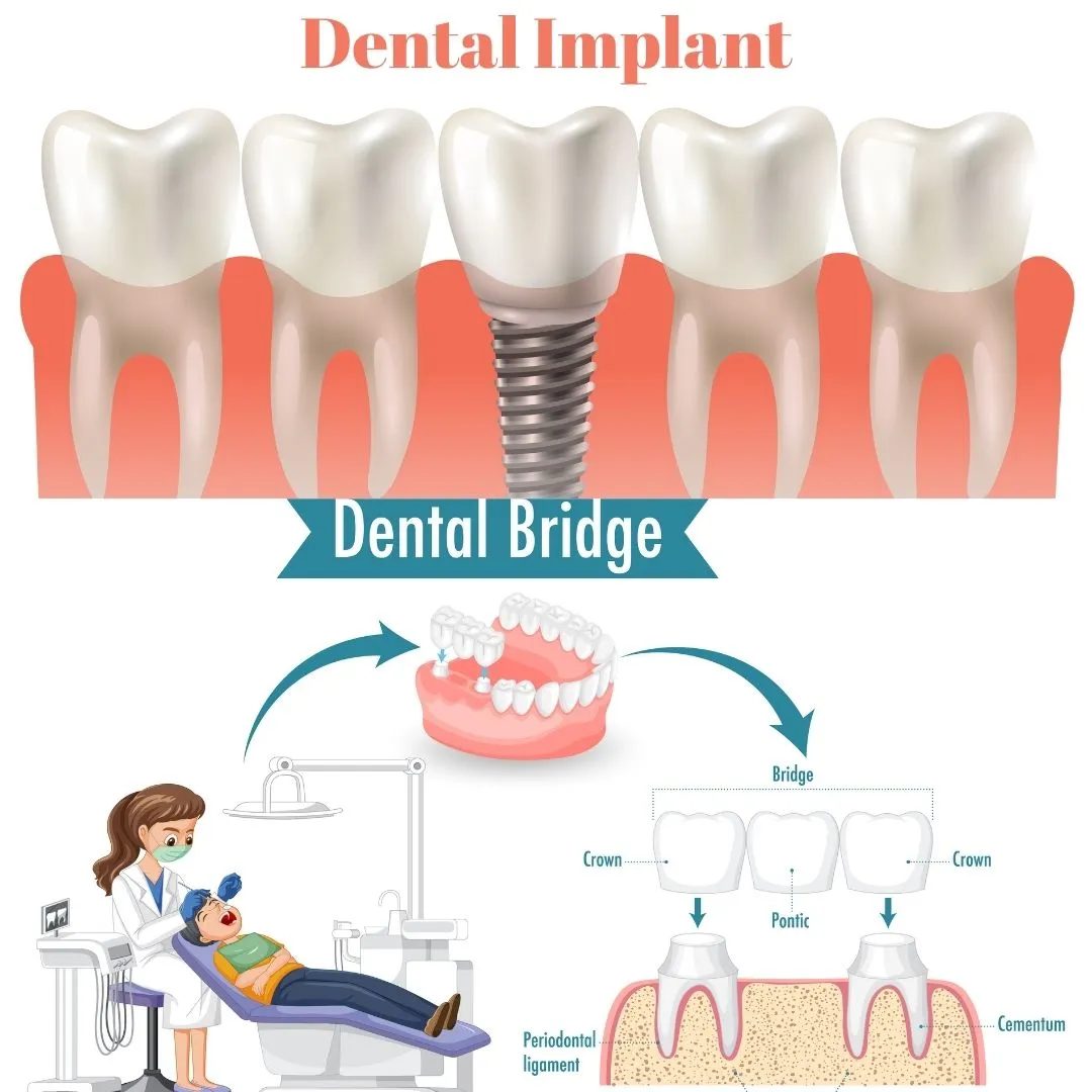 Illustrative example of dental implant versus bridge cost from Google Search