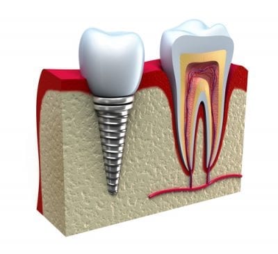 Illustrative example of dental implants abroad from Google Search
