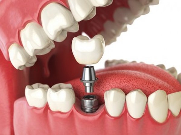 Illustrative example of dental implants after extraction from Google Search