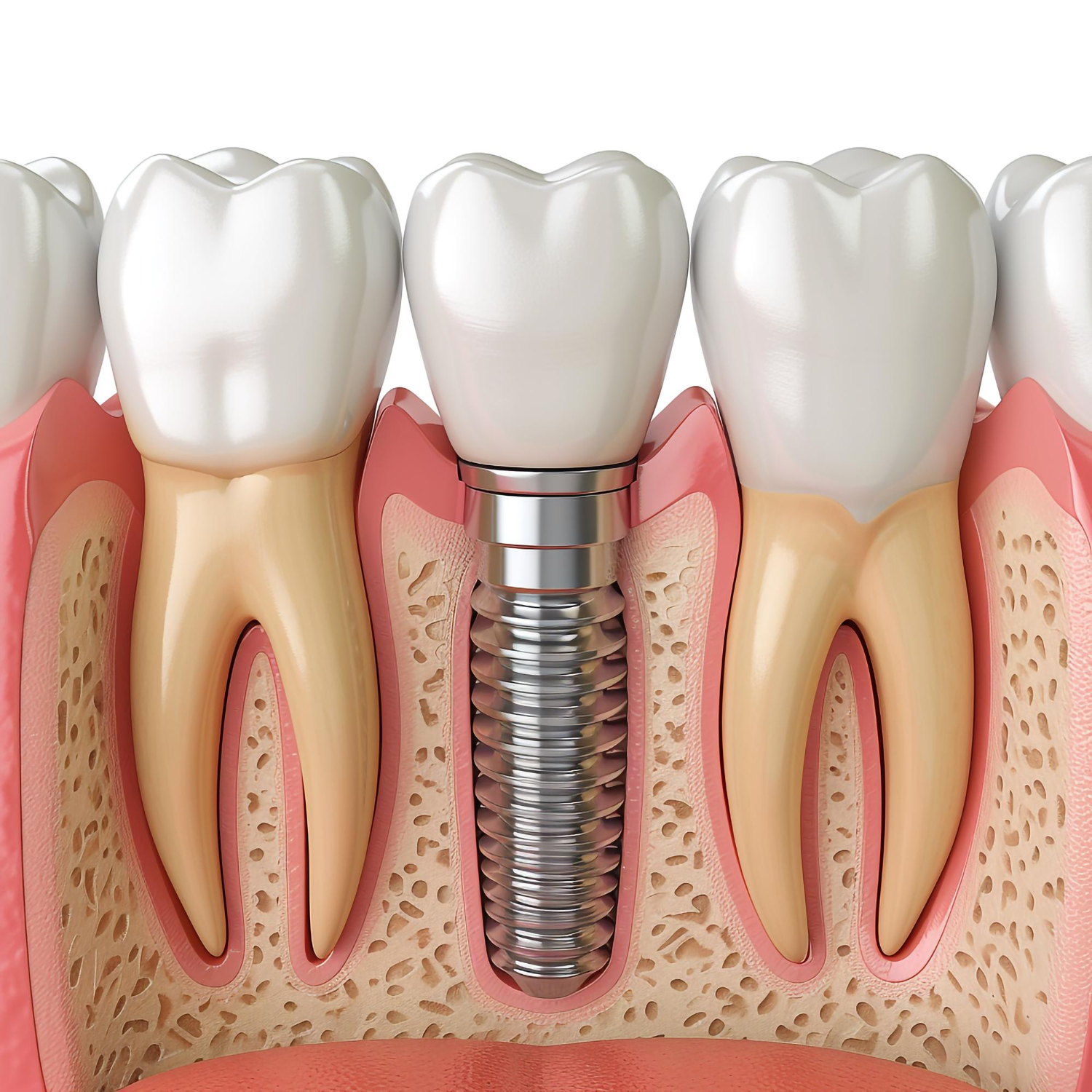 Illustrative example of dental implants and braces from Google Search
