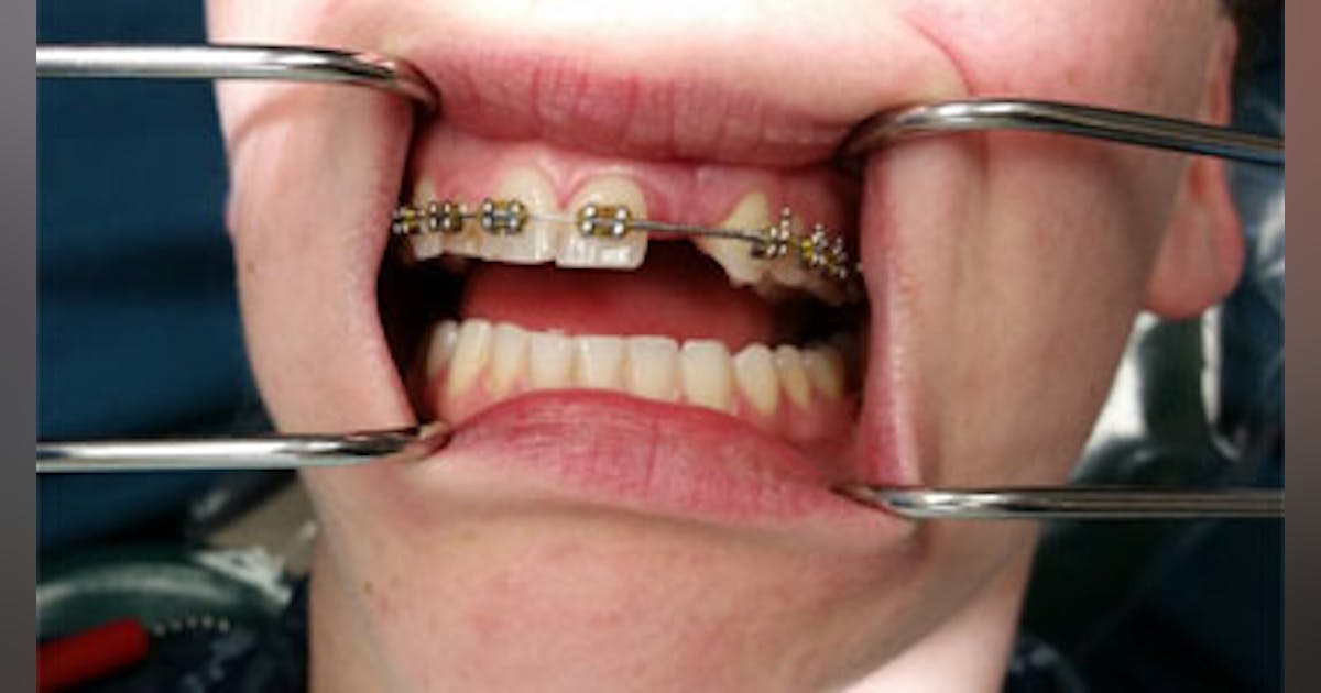 Illustrative example of dental implants and braces from Google Search