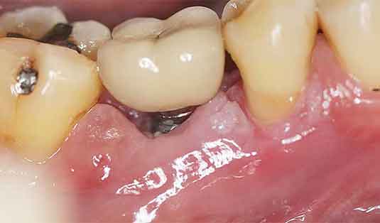 Illustrative example of dental implants and gum disease from Google Search