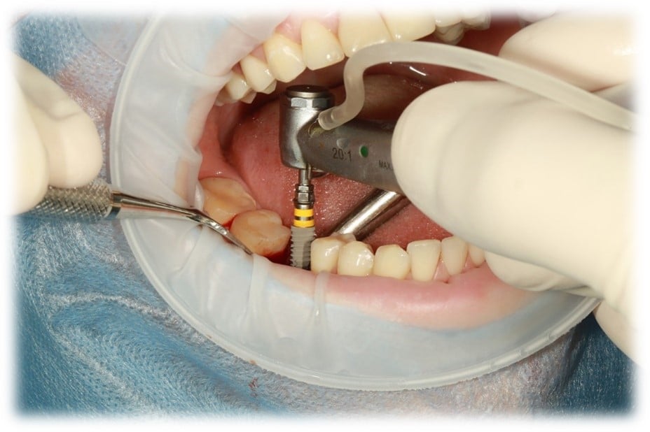 Illustrative example of dental implants and mri from Google Search