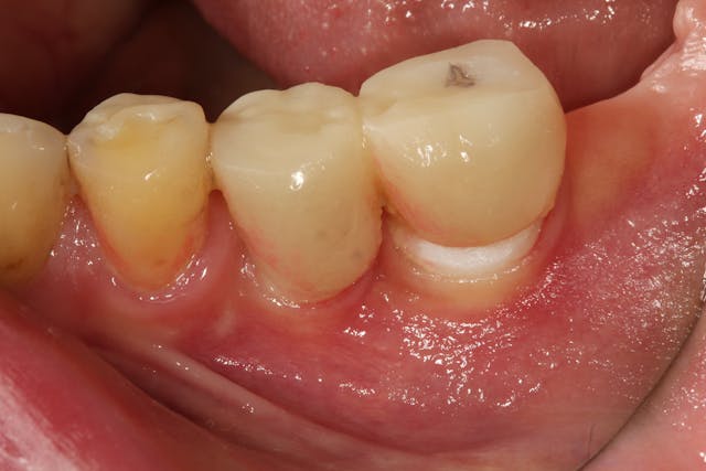 Illustrative example of dental implants and pain from Google Search