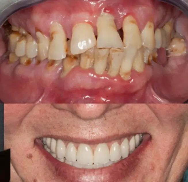 Illustrative example of dental implants and periodontal disease from Google Search