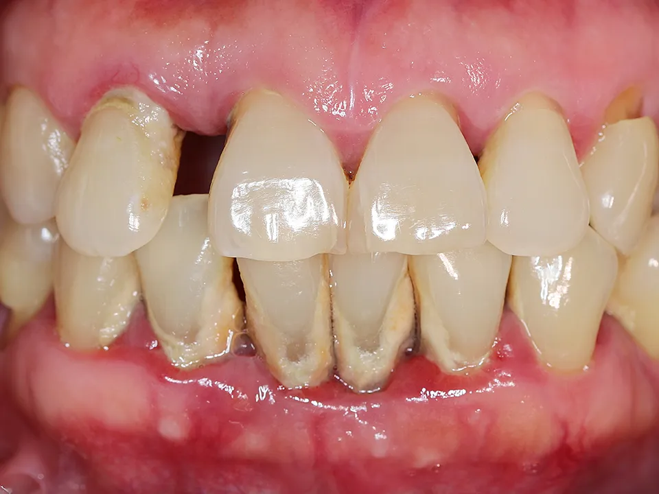Illustrative example of dental implants and periodontal disease from Google Search