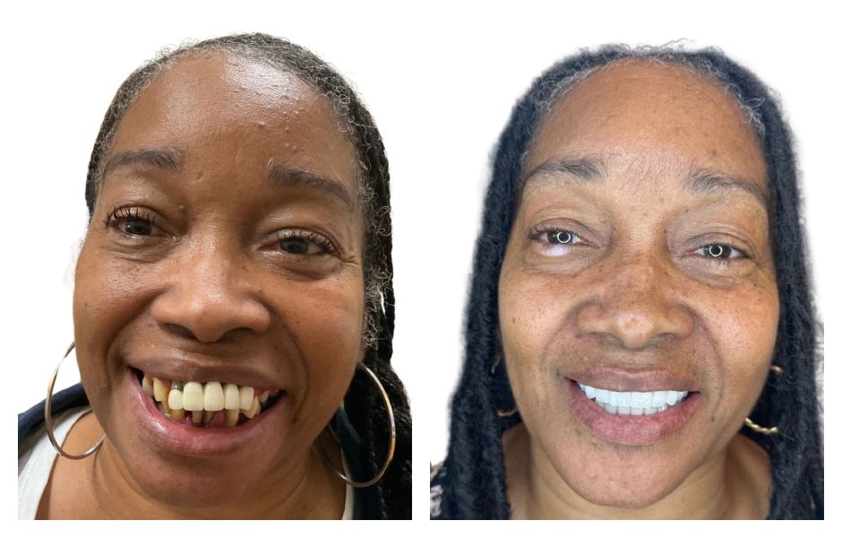 Illustrative example of dental implants before and after photos from Google Search