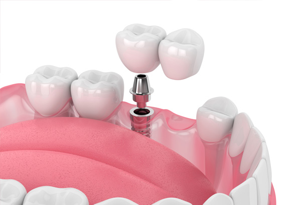 Illustrative example of dental implants bridge from Google Search