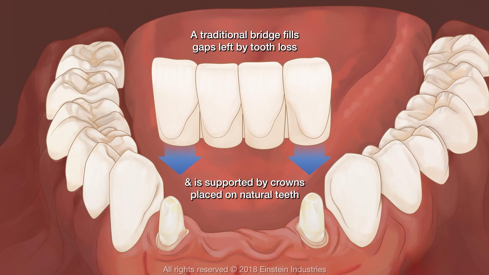 Illustrative example of dental implants bridge from Google Search
