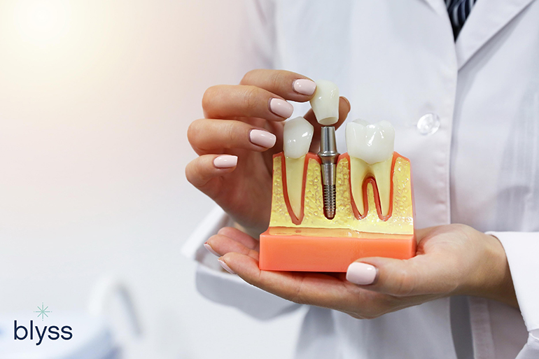 Illustrative example of dental implants cons from Google Search