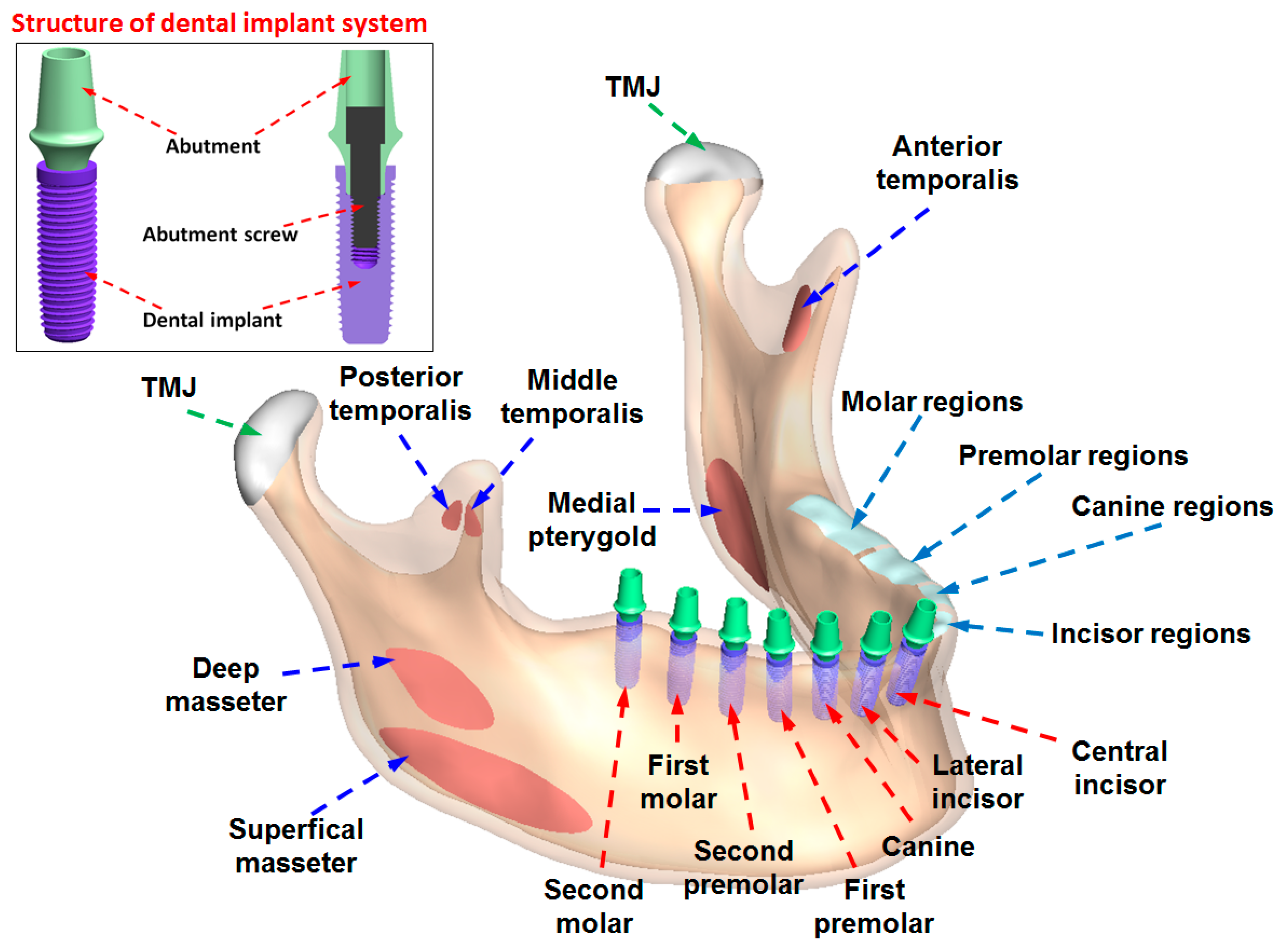 Illustrative example of dental implants diagram from Google Search