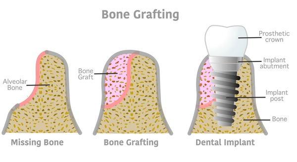Illustrative example of dental implants diagram from Google Search