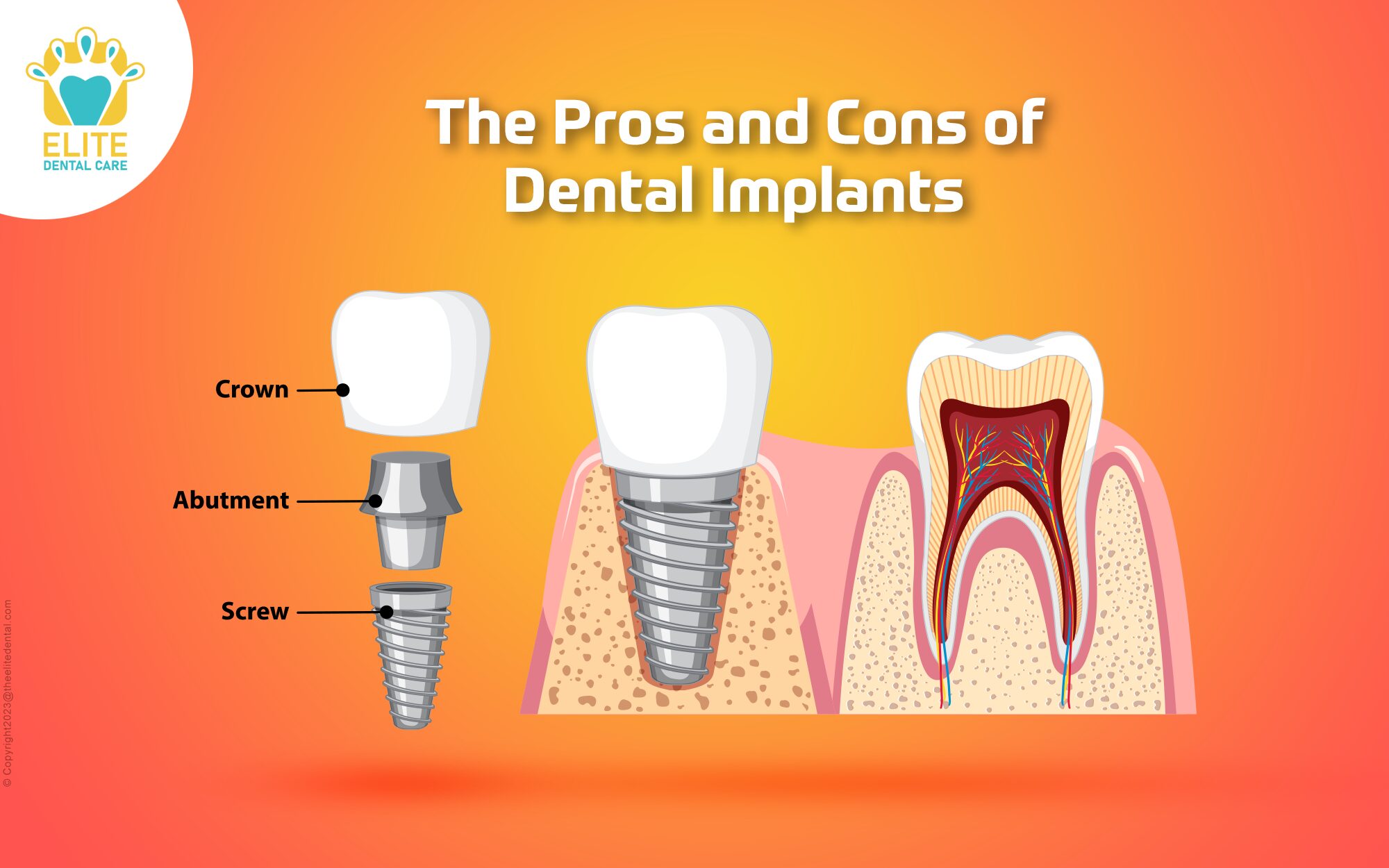 Illustrative example of dental implants drawbacks from Google Search