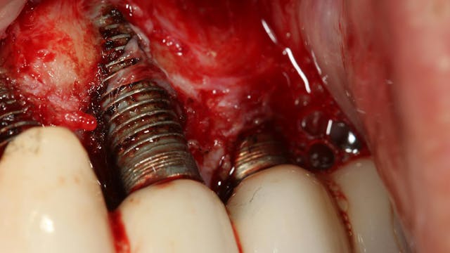 Illustrative example of dental implants failure from Google Search