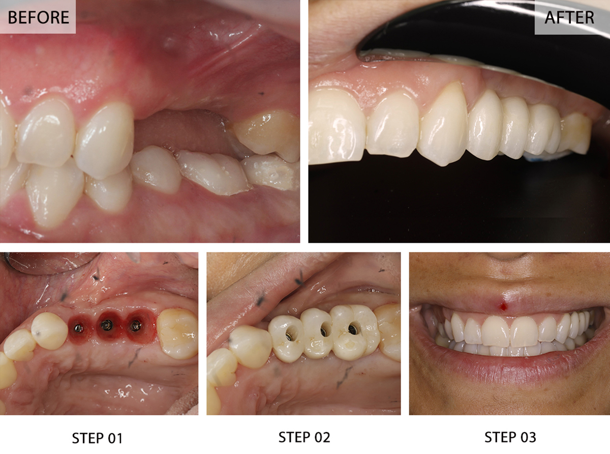 Illustrative example of dental implants for back teeth from Google Search