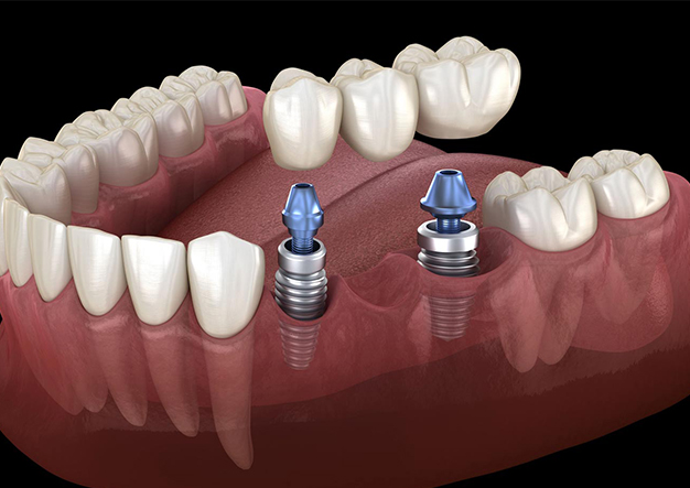 Illustrative example of dental implants for bridges from Google Search