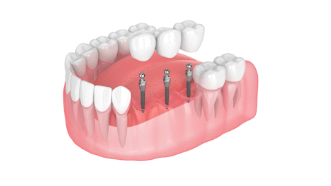 Illustrative example of dental implants for bridges from Google Search