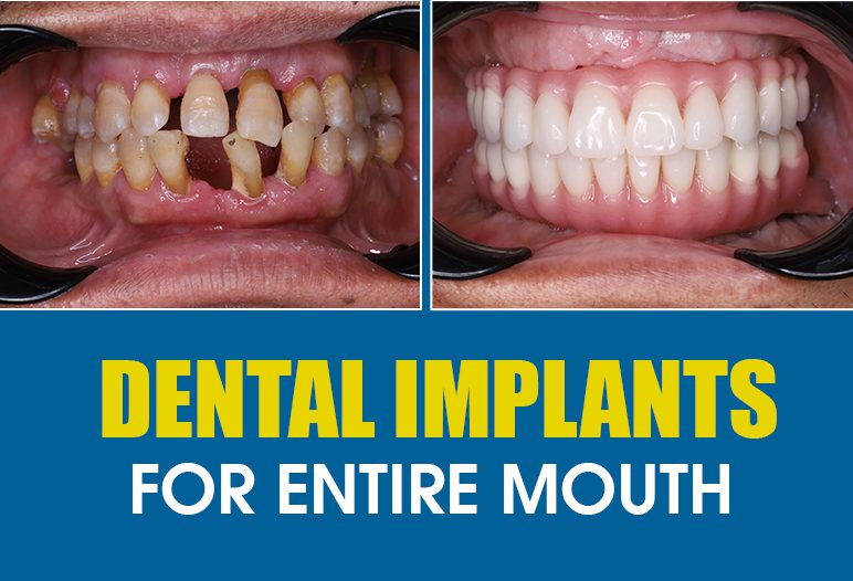 Illustrative example of dental implants for entire mouth from Google Search