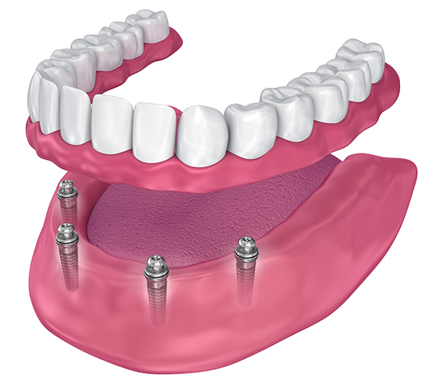 Illustrative example of dental implants for lower dentures from Google Search