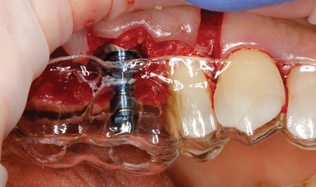 Illustrative example of dental implants for molars from Google Search