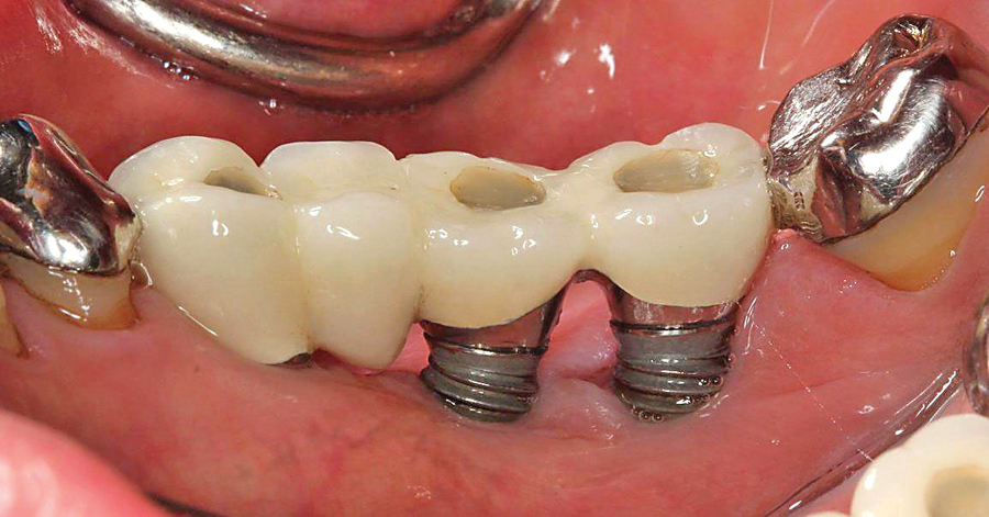 Illustrative example of dental implants infection symptoms from Google Search