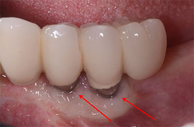Illustrative example of dental implants infection symptoms from Google Search