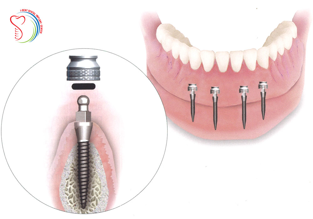 Illustrative example of dental implants mini from Google Search