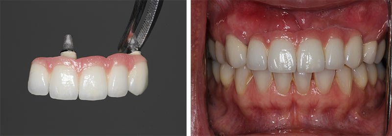 Illustrative example of dental implants multiple teeth from Google Search