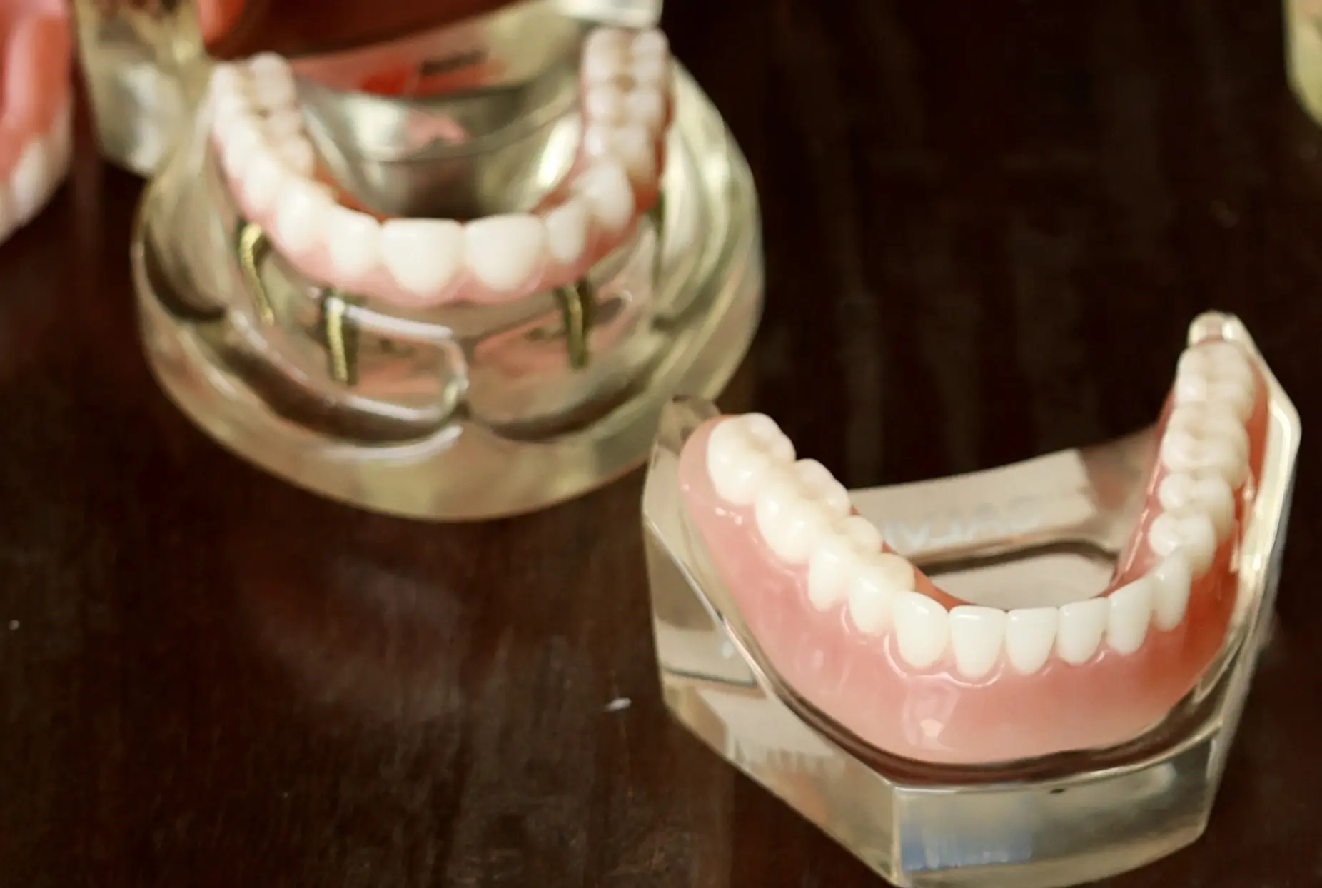 Illustrative example of dental implants permanent dentures from Google Search