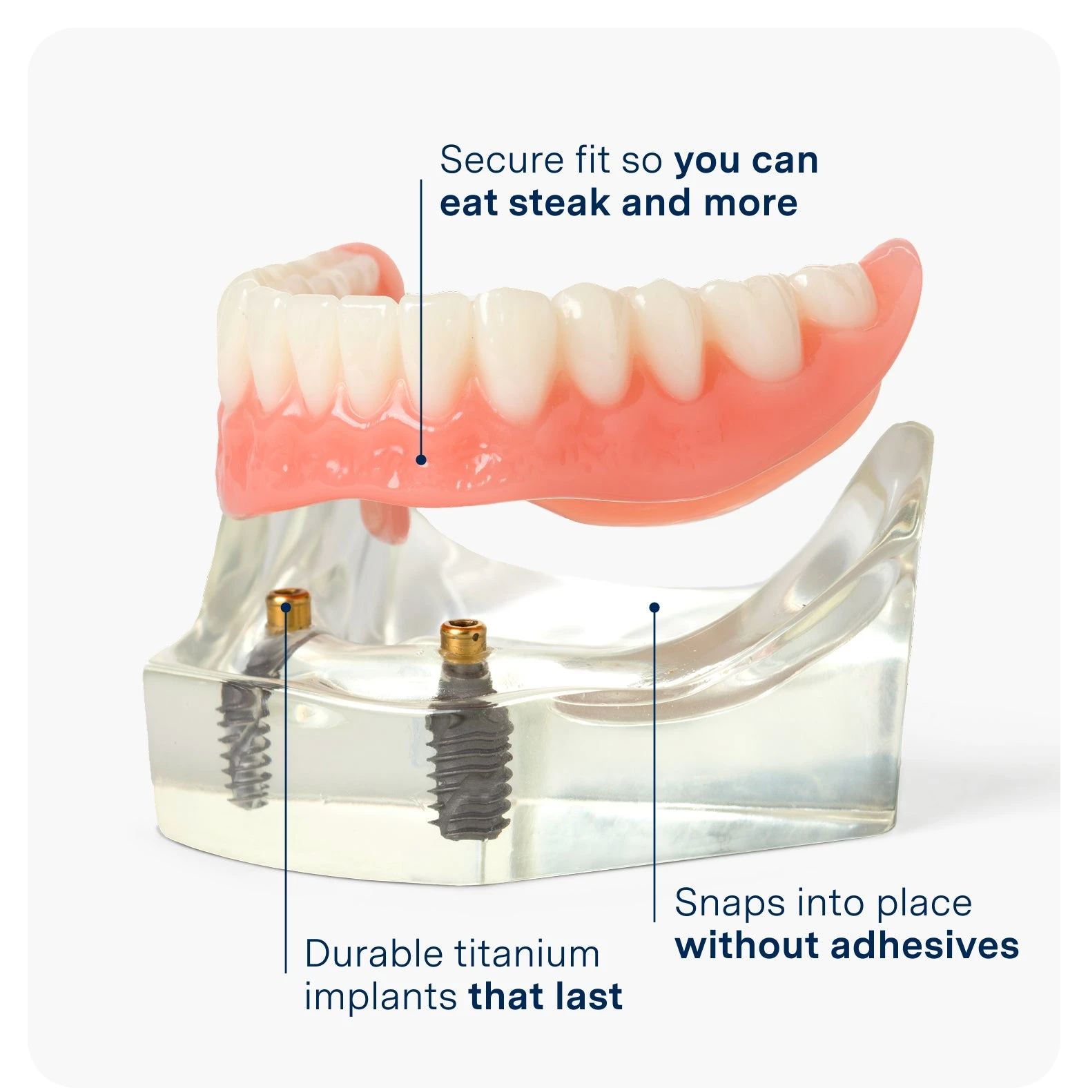 Illustrative example of dental implants permanent dentures from Google Search